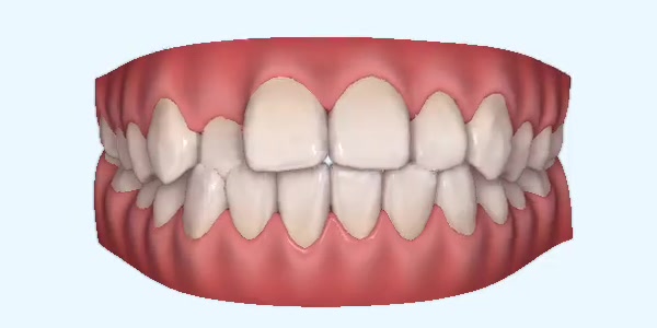 crossbite