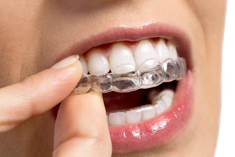 Invisalign